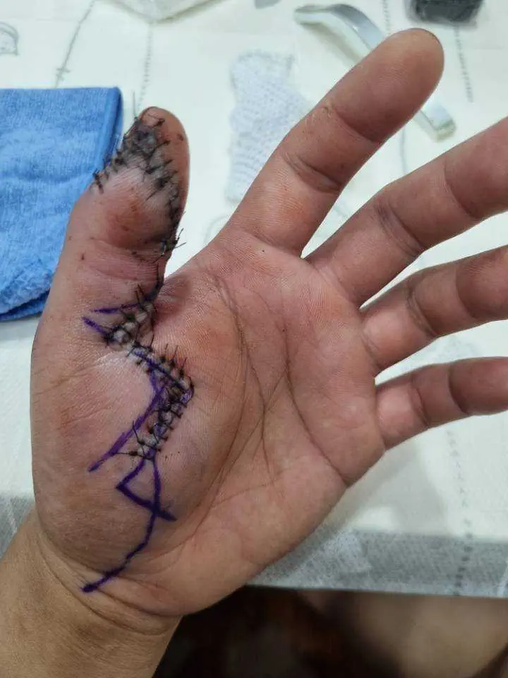 Stitched hands caught in atable saw